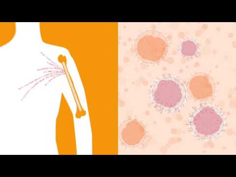 Vídeo: Diferencia Entre Leucemia Y Mieloma Múltiple