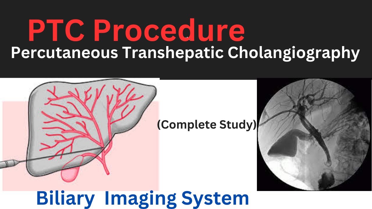 Percutaneous Transhepatic Cholangiography (PTC) X-ray procedure| PTC X ...