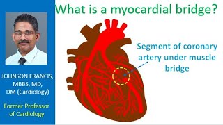 What is a myocardial bridge?