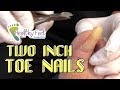 Two Inch Toenails!  Long, Painful, Incurvated Nails!