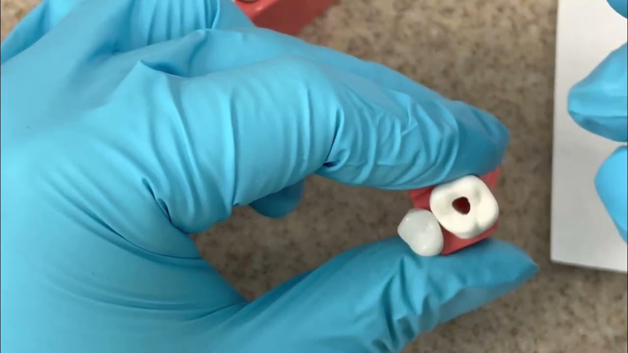 How to pass the CDCA ADEX Dental Exam Part 3 Endo/Prosth YouTube