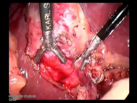 Lap Cholecystectomy 20150408 Unedited Chr  Case With Strong Adhesion Bad Case