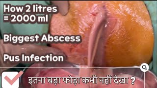 2 liters of PUS  VERY VERY BIGGEST ABSCESS  How surgery to drain Abscess infection  CELLULITIS