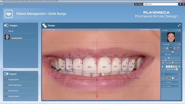 Planmeca Romexis® Smile Design - Smile Design in 2 Minutes!