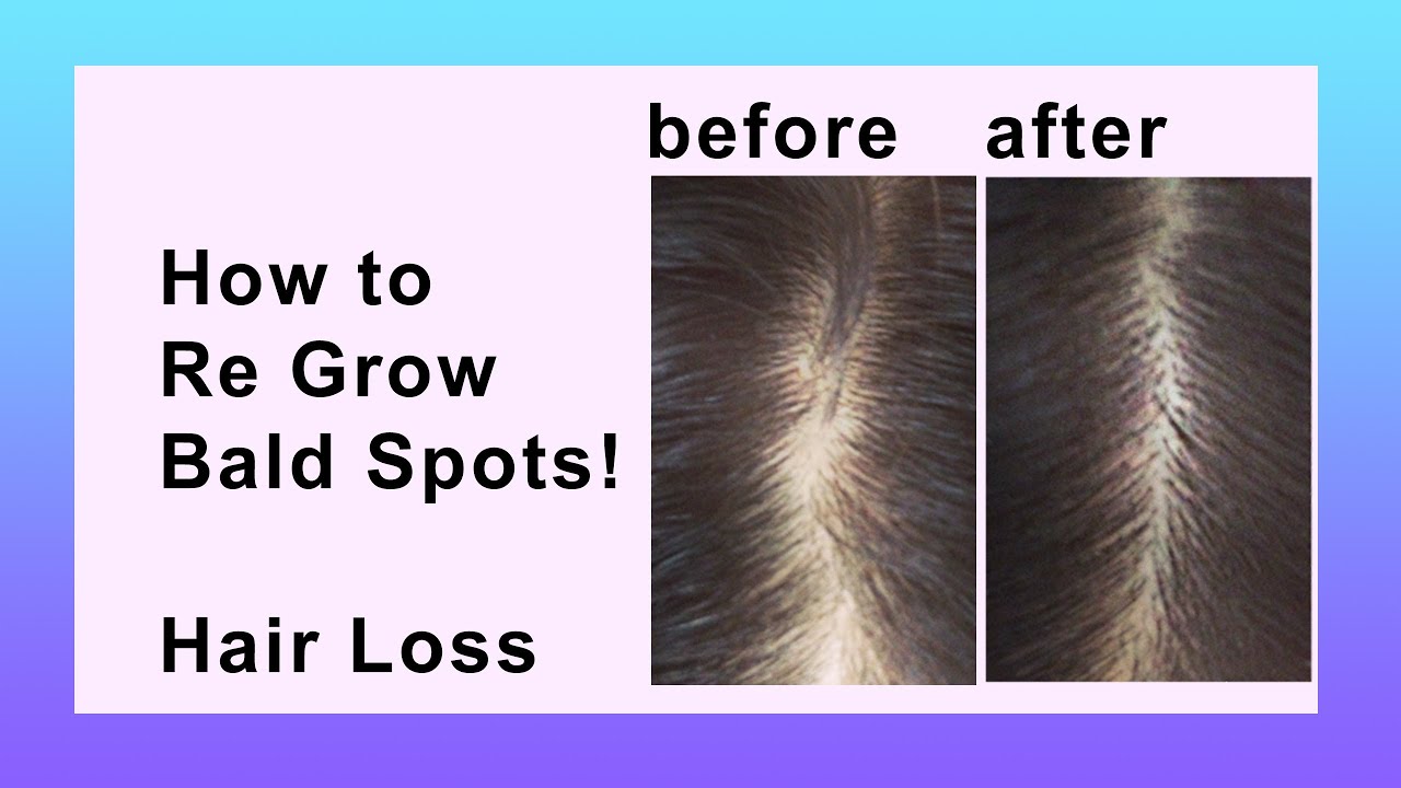Hair Loss Natural Home Remedy YouTube