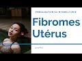 Embolisation des fibromes utérins ou Myomectomie ?