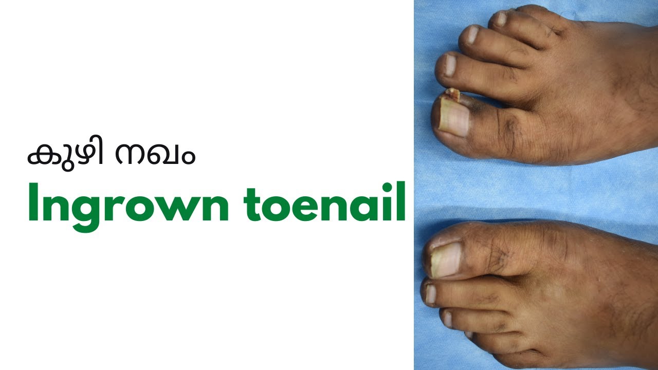 INGROWN TOE NAIL by senthil kumar on Prezi