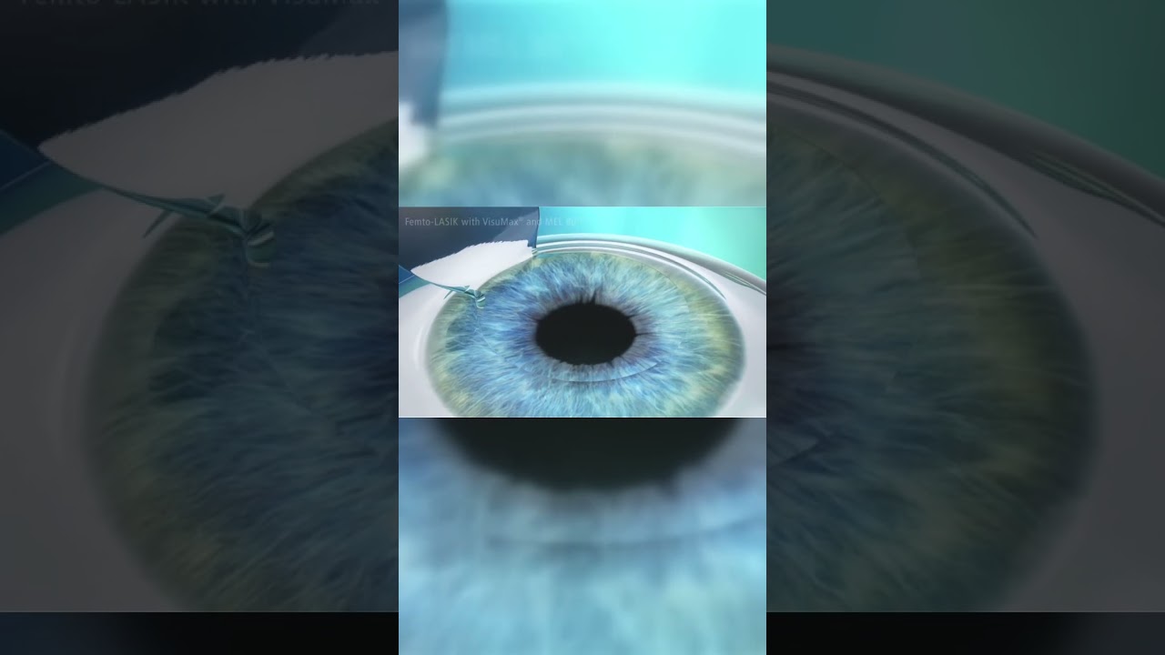 This is how LASIK eye surgery works! #lasik #eye #animation #shorts #music #new