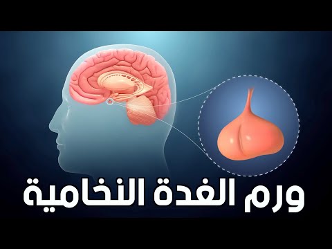أورام الغدة النخامية الأعراض والأسباب