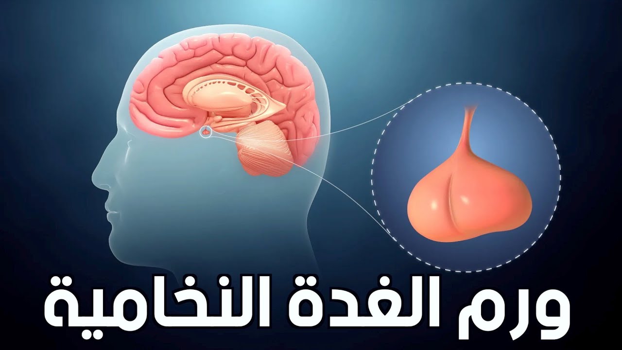 أورام الغدة النخامية  | الأعراض والأسباب