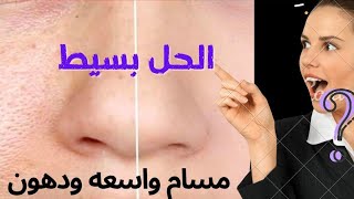 مشاكل البشرة الدهنيه / التخلص من المسامات الواسعة في الوجه باسهل طريقة وفعاله جدا