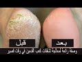 وصفه سحريه للتخلص من تشققات القدمين بي البيكنج بودر اها بي البيكنج بودر
