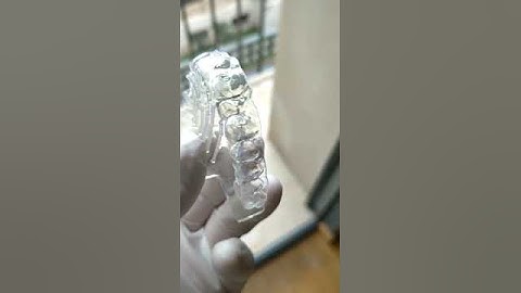 3Dresyns 3D printed aligner printed with 3Dresyn OD-Clear TF LTP Rigid (www.3dresyns.com)