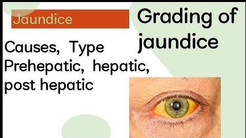Jaundice|Causes |Types |Grading #jaundice #medicine #patienthistory #examination