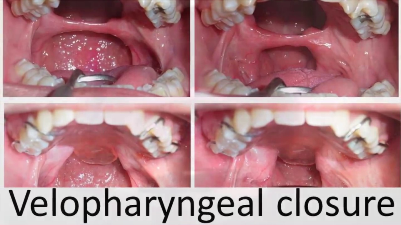 Velopharyngeal Closure 60 YouTube