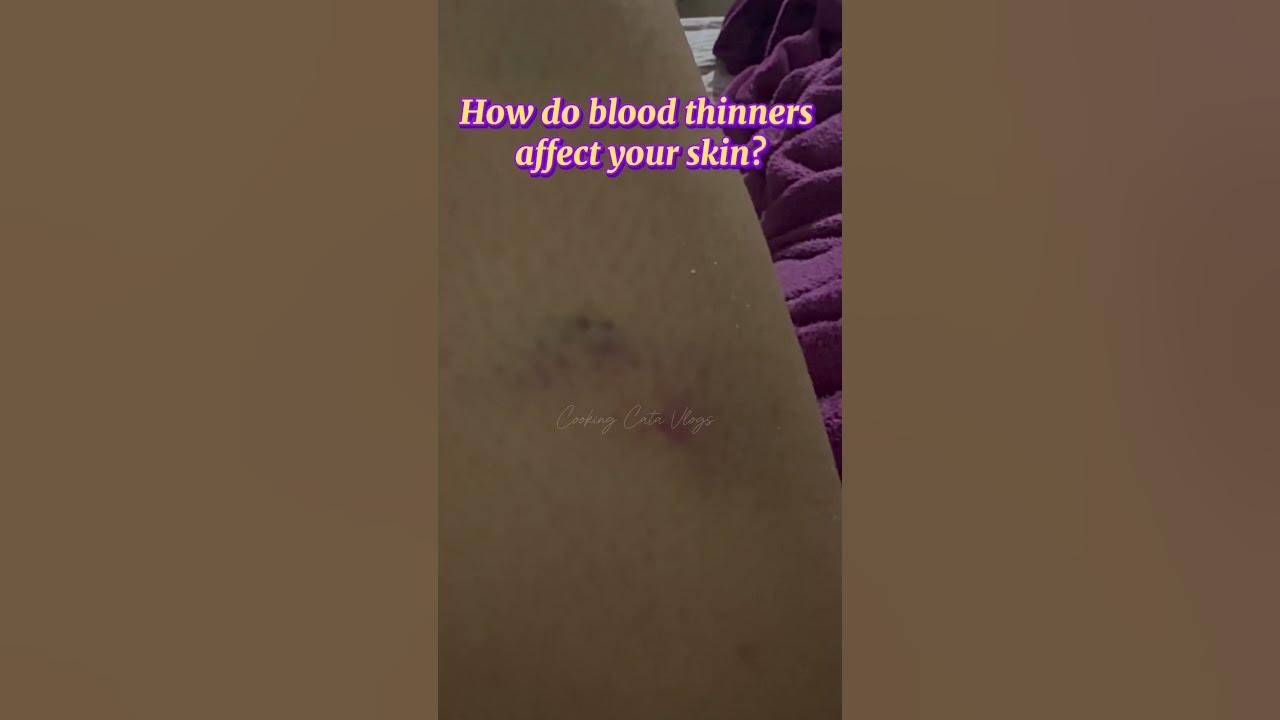 How Do Blood Thinners Affect Your Skin bruises bloodclot how-do-blood-thinners-affect-your-skin-bruises-bloodclot