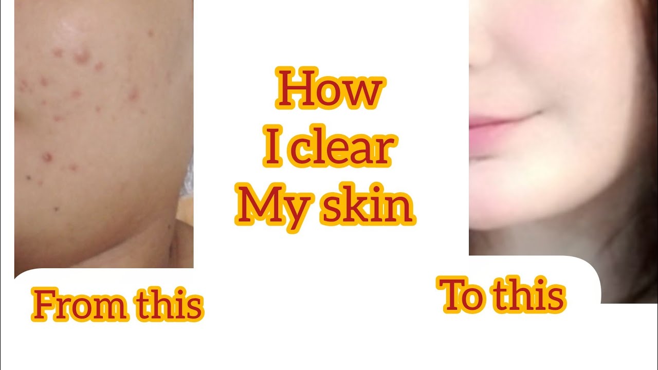 My acne journey how I achieved clear skin from alots of pimples to ...