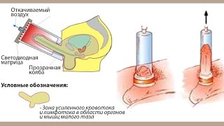 Как лечить импотенцию в домашних условиях