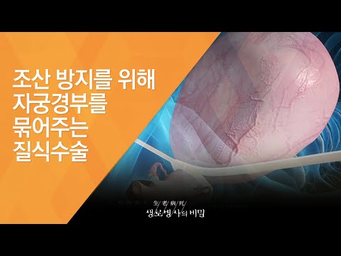 조산 방지를 위해 자궁경부를 묶어주는 질식수술 - (20140212_493회 방송)_출산의 두려움, 조산