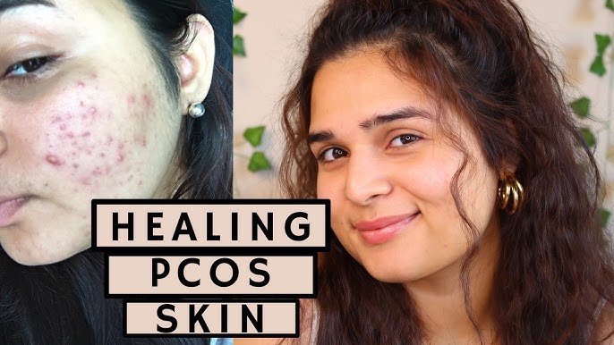 polycystic ovarian syndrome acne