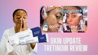 UPDATED ACNE JOURNEY / TRETINOIN REVIEW