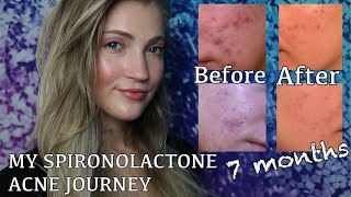 SPIRONOLACTONE FOR HORMONAL ACNE (BEFORE + AFTER PICTURES) MY EXPERIENCE AND WHY I STOPPED TAKING IT