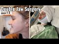 Double Jaw Surgery | Days 1-3 Post-op