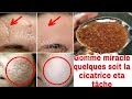 GOMME ENLÈVE TOUTE TYPES DE CICATRICES / VIELLES CICATRICES OU NOUVELLES...