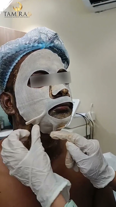 Dermamelan Peel for Pigmentation | Skin Brightening & Melasma Treatment Tamira Life | Chennai