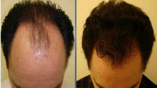 Everyone is talking about this natural mask that makes hair grow. He is impressive screenshot 2