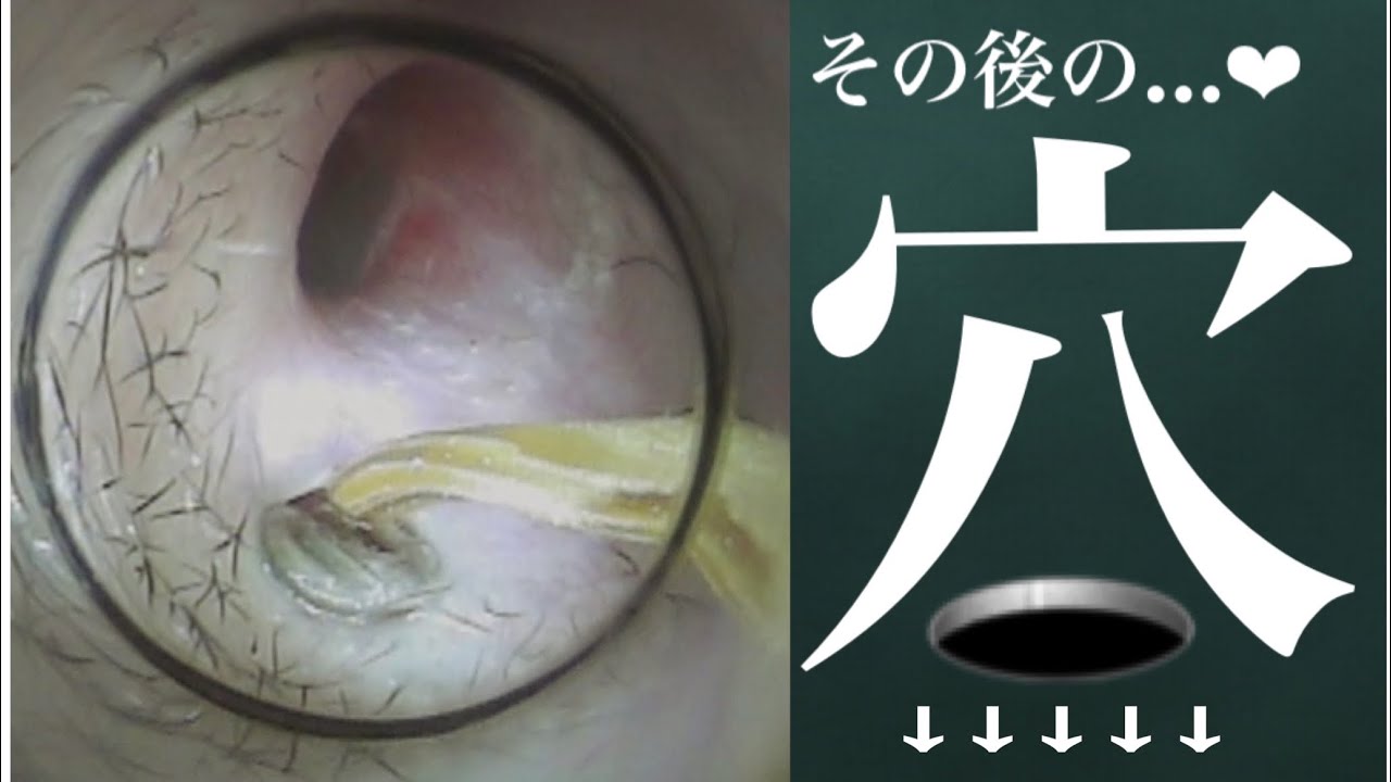 耳 瘻孔 気持ちいい