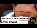 The End of the Ketchup Bottle Lipoma