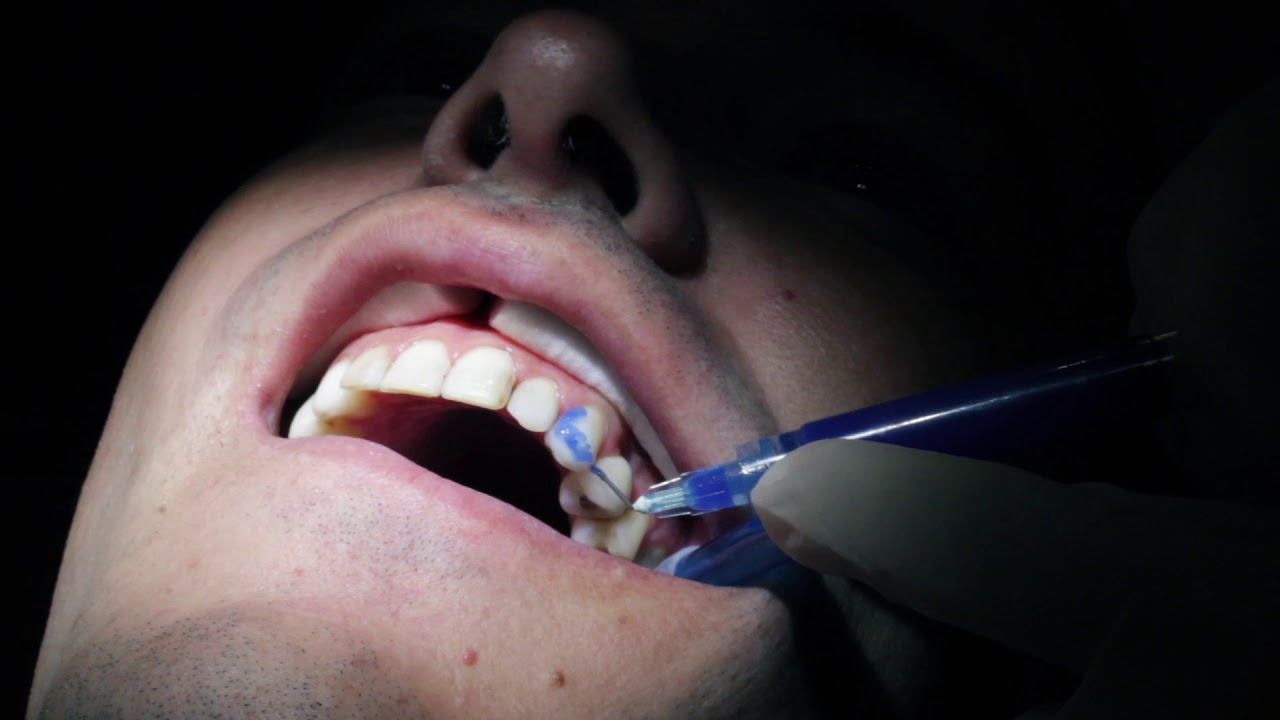 Qu Son Las Carillas Dentales Colocaci n De Carillas Dentales Paso