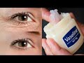 In 3 days Remove Under Eye Bags Completely | Remove Dark Circle, Wrinkles, puffy Eye