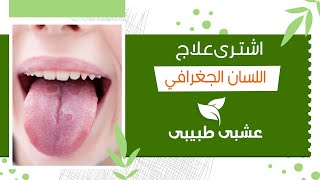 دواء علاج اللسان الجغرافي | 11 عشب طبيعي لعلاج اللسان الجغرافي - التهاب اللسان 