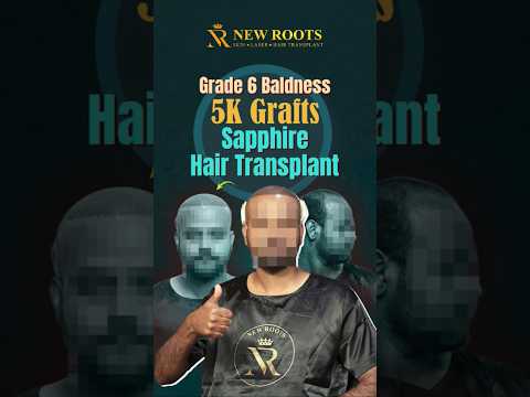 Sapphire Hair Transplant Surgery | Grade 6 Baldness | Hyderabad #sapphirehairtransplant #shorts