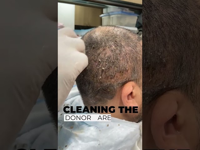 Head Wash After Hair Transplant | 1st Head Wash | Scabs Removal class=