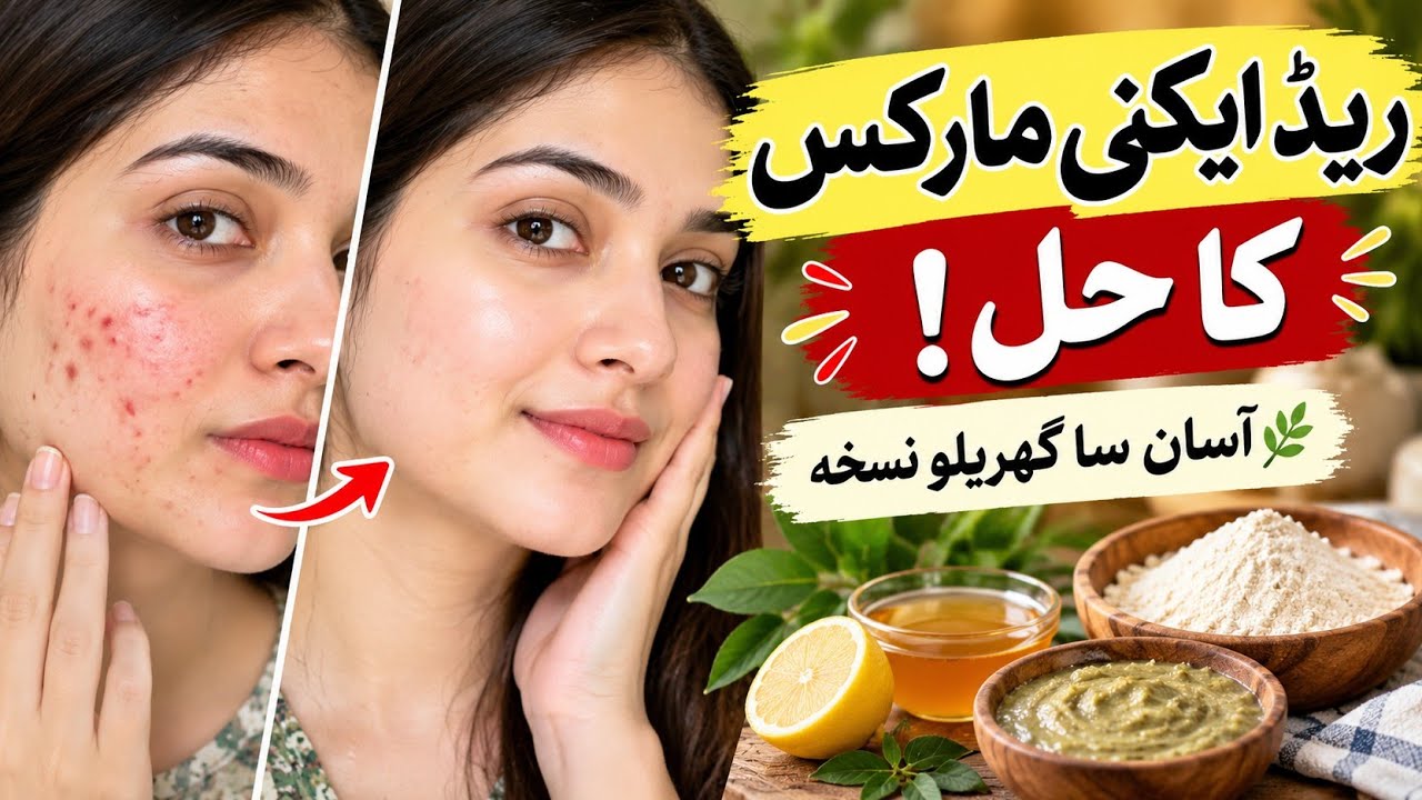 Marcas Rojas “Remove Red Acne Marks in 7 Days | No More Dark Spots Naturally” - YouTube