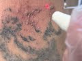 Видалення татуювання лазером із використанням повітряної кріо установки 🔝