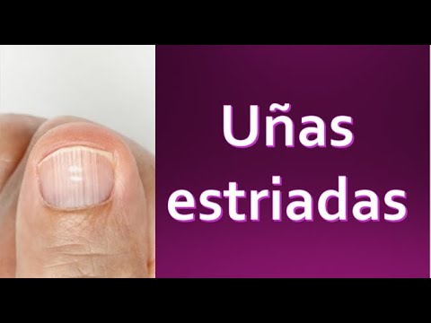 Tipos de uñas débiles estriadas Problemas  soluciones  Nailistas   Esmaltes permanentes y productos de uñas  Tienda online de esmaltes  permanentes polygel y productos de uñas Envío 24h gratis a