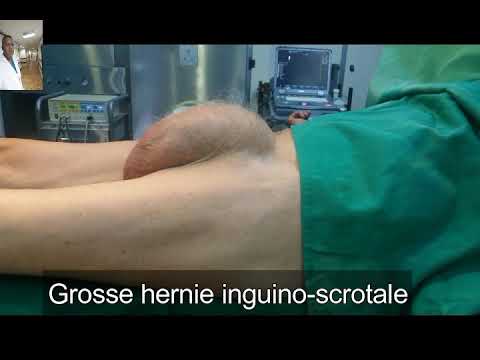 Vidéo: Œdème Scrotal: Causes, Traitement, Photo, Comment éliminer L'œdème