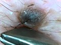 ほくろの毛を引っこ抜く！part6 Hair of a mole!