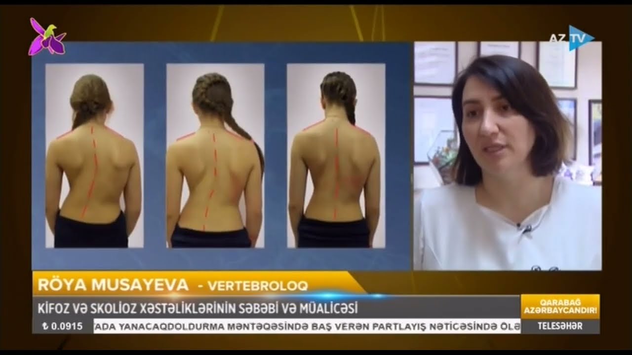Kifoz və skolioz xəstəlikləri nədən yaranır?