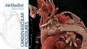 Thoracic Endovascular Repair of Rapidly Expanding False Lumen of Chronic Type III Aortic Dissection