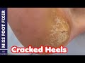HOW TO TREAT DRY , CRACKED HEELS *** CRACKED FOOT TREATMENT *** BY MISS FOOT FIXER