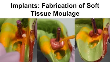 4. Implants: Fabrication of Soft Tissue Moulage