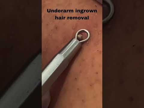 Video: 3 måter å fjerne et inngrodd hår under huden