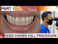 Step by step redo dental crown part 1  general dentist griya rr