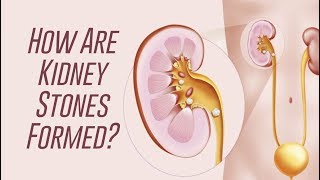How Kidney Stones are Formed?