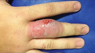 CPT code for Incision and drainage multiple - simplify medical coding